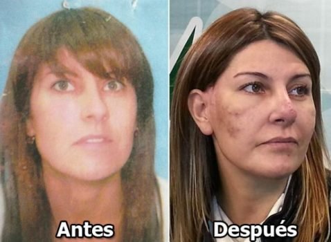 malapraxis_acidohialuronico